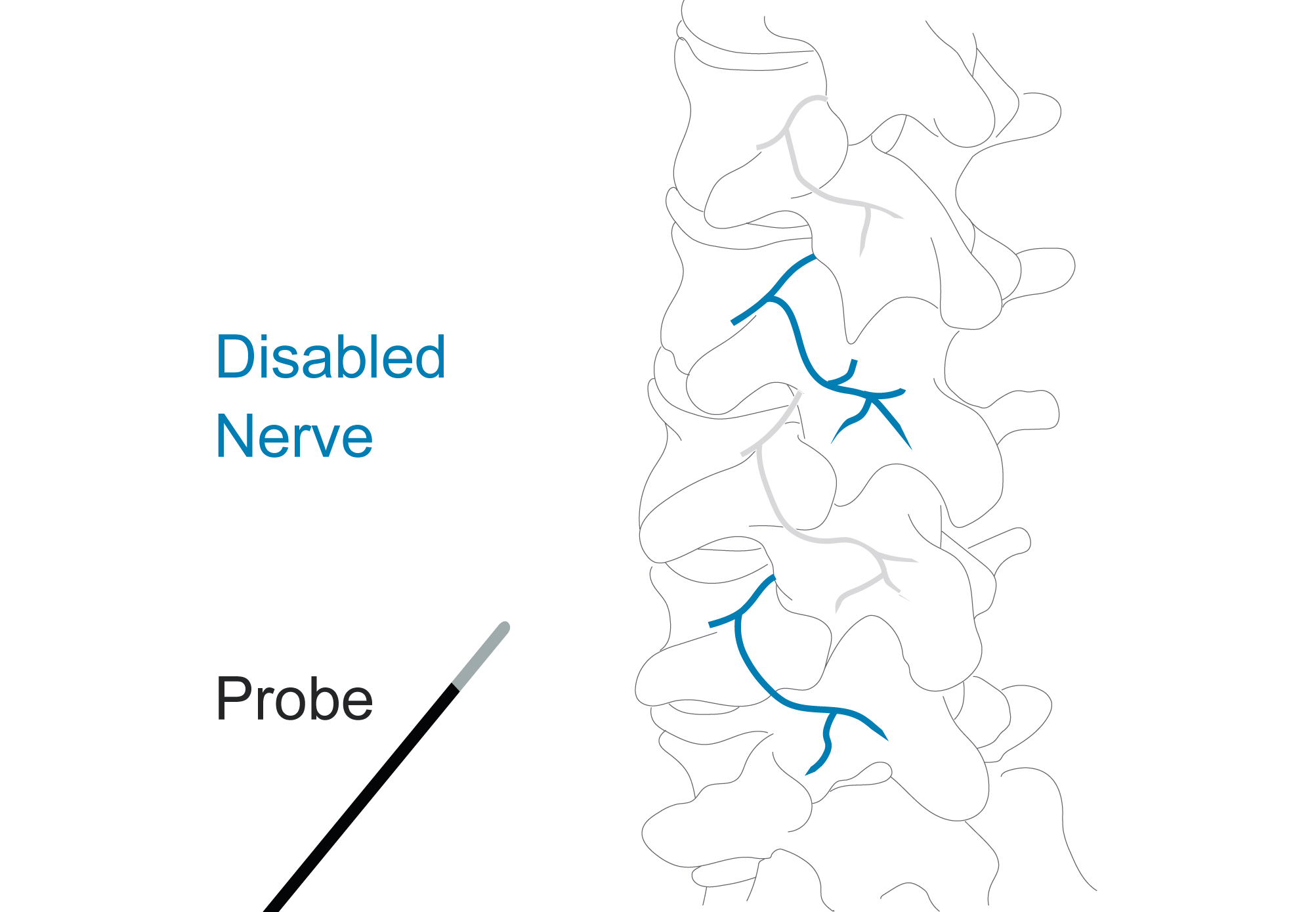 Diagram of the spine showing multiple disabled nerves after the probe has been removed.