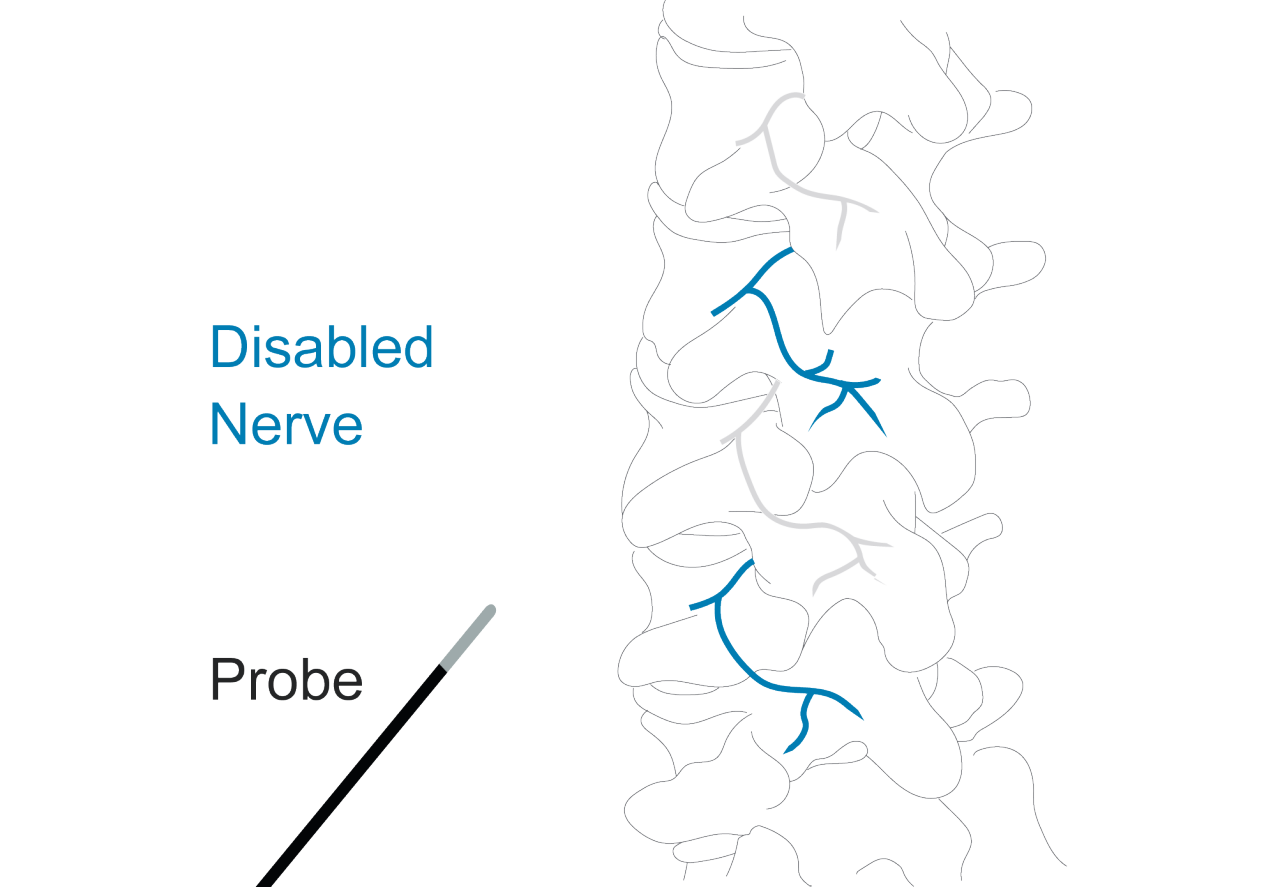 Diagram of the spine showing multiple disabled nerves after the probe has been removed.